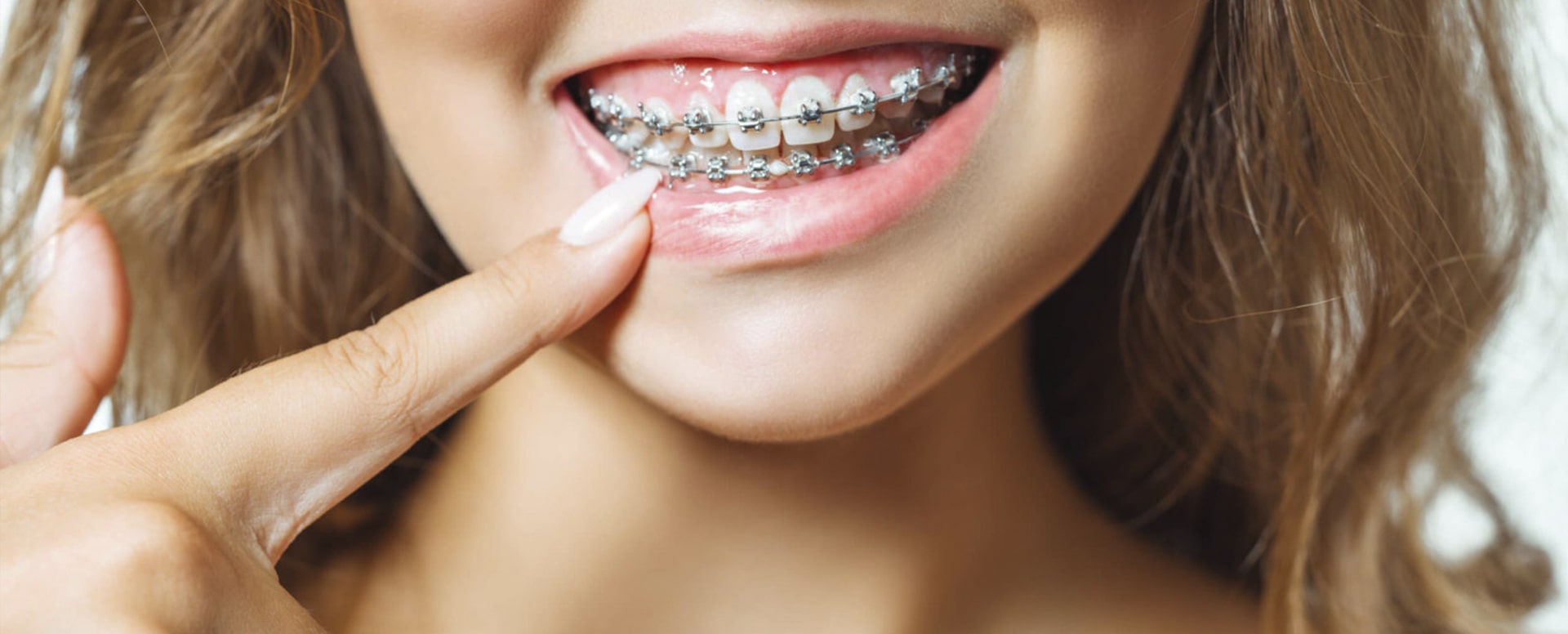 Ορθοδοντικά Μίνι - Εμφυτεύματα (Orthodontic Mini Implants)