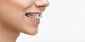 Αόρατες Τεχνικές Ορθοδοντική Κλινική Κατερίνη Orthodontic Smiles Clinic